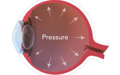 What is Elevated Intraocular Pressure and How Can It Impact Your Vision?