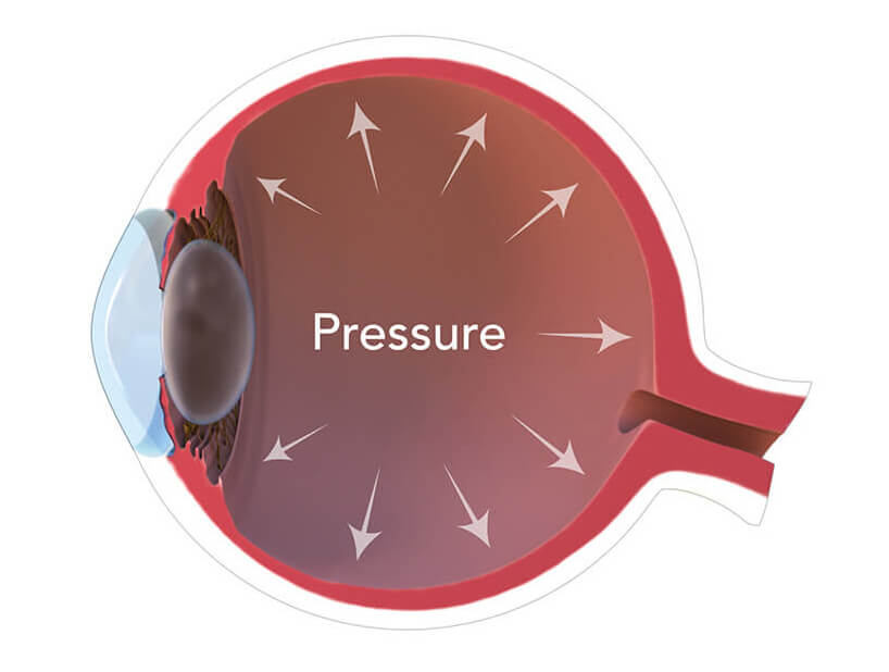 What is Elevated Intraocular Pressure and How Can It Impact Your Vision?